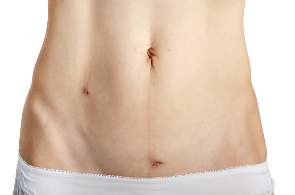 Appendix surgery scars (Photo: Shutterstock) ניתוח תוספתן