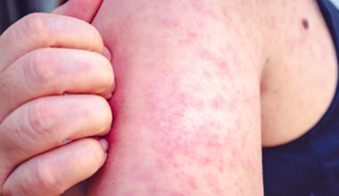 Measles exposure alert issued for SW Calgary medical clinic