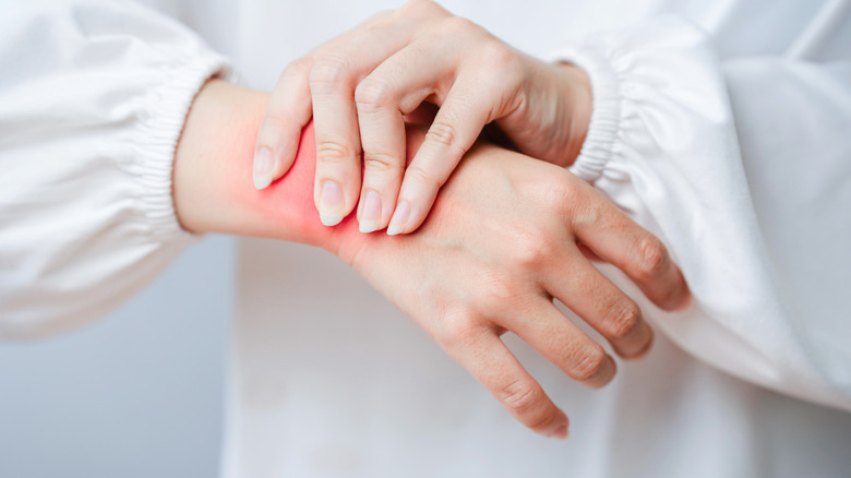A woman clutching her wrist with red skin