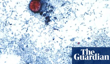 Is the cyclosporiasis outbreak slowing? Test-makers are hopeful | Infectious diseases