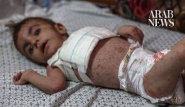 Chickenpox cases surge past 18,000 in Gaza as disease outbreak spreads, UN says