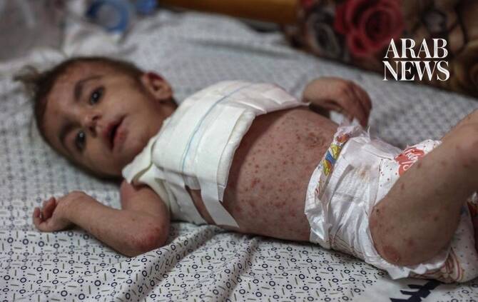 Chickenpox cases surge past 18,000 in Gaza as disease outbreak spreads, UN says