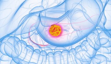 Experimental Drug Stops 90% of Pancreatic Cancer Cell Spread in Lab Tests : ScienceAlert