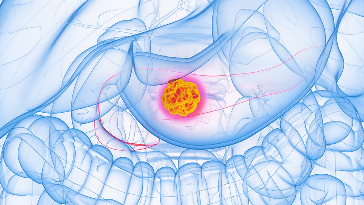Experimental Drug Stops 90% of Pancreatic Cancer Cell Spread in Lab Tests : ScienceAlert