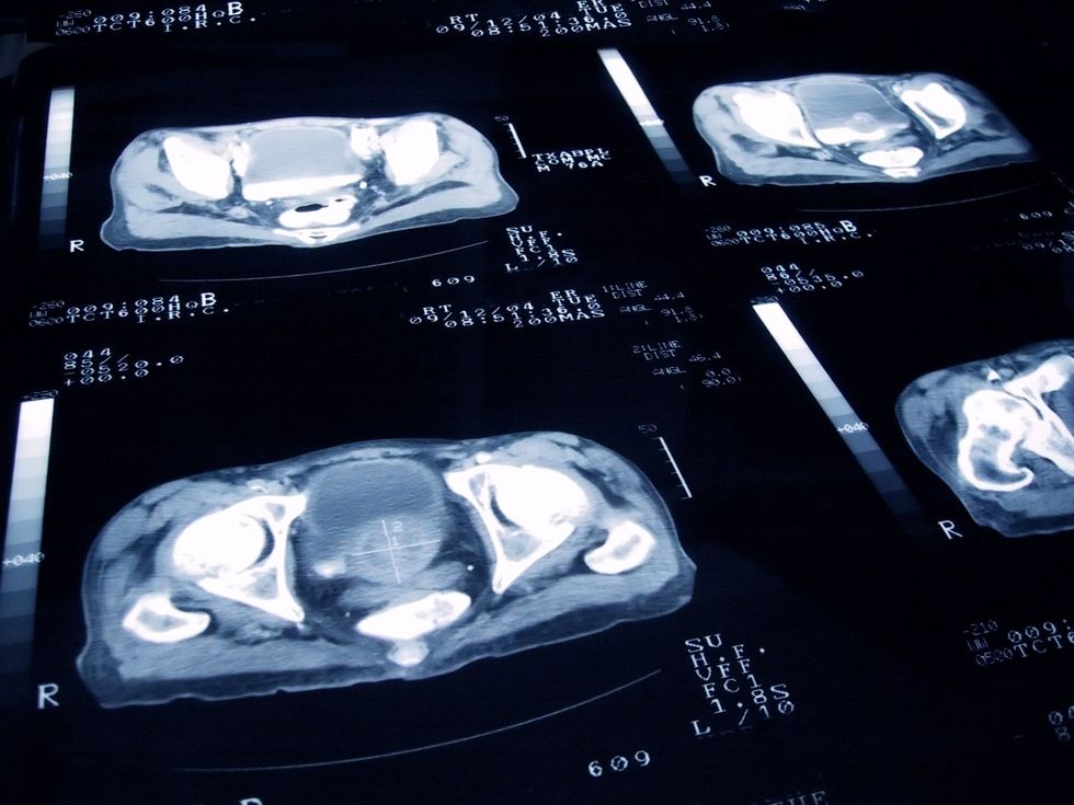 PROSTATE SCAN