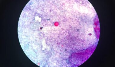 Parasite Outbreak Sickens People In 17 States, Including PA