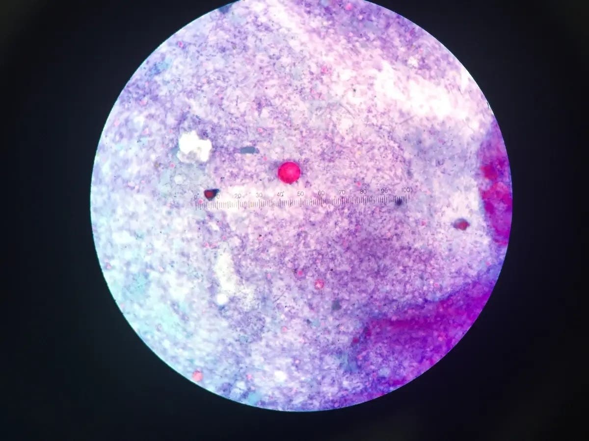 Parasite Outbreak Sickens People In 17 States, Including PA