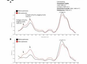 Cleaning cholesterol from blood also lowered forever chemicals and plastics, and nobody knows why