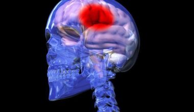 New stroke drug reduces brain damage by 60 percent in preclinical study | News