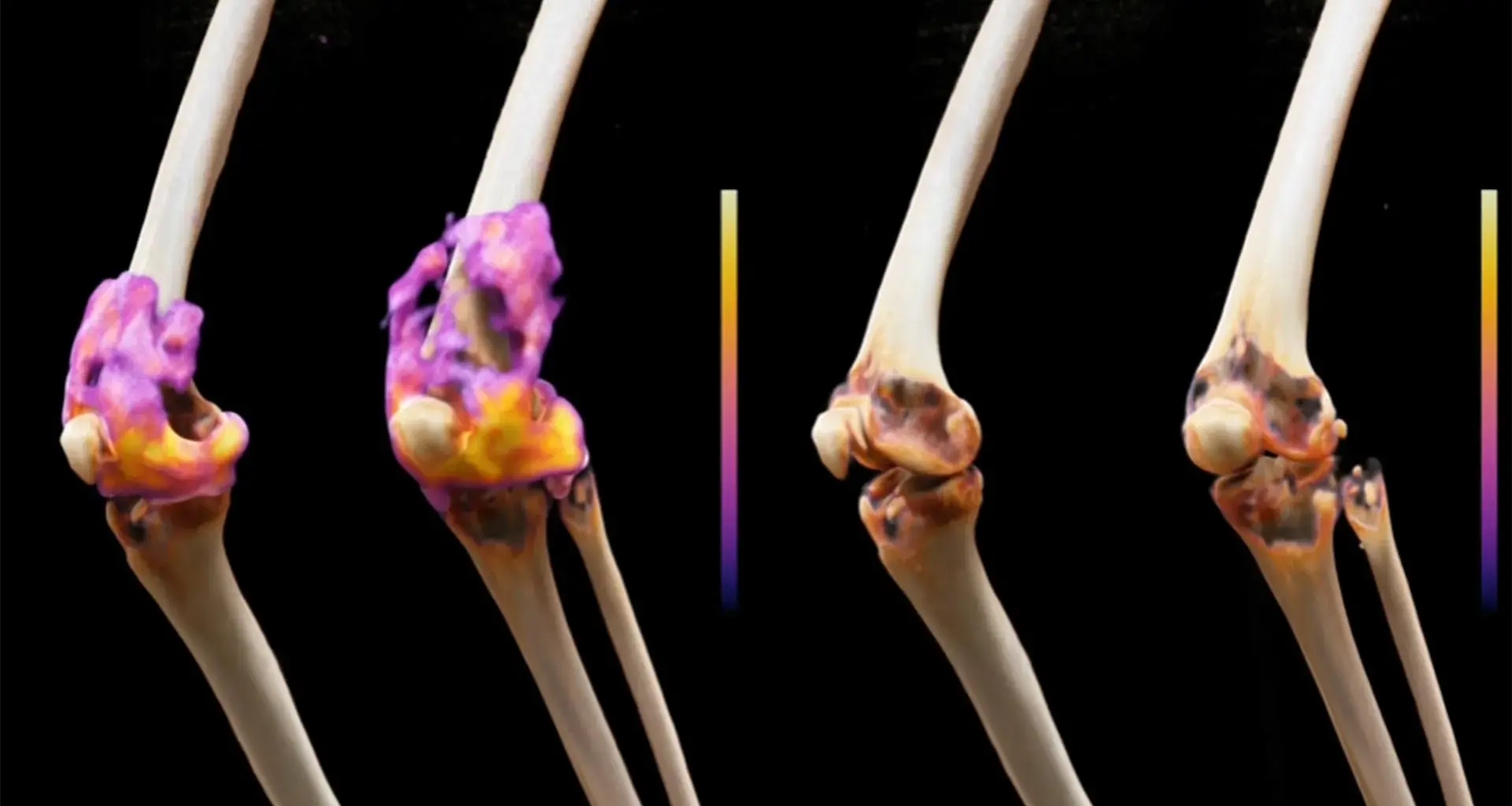 A cancer therapy put severe rheumatoid arthritis into remission