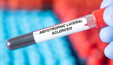 ALS blood biomarker N-acyl taurine linked to disease progression and new treatment strategy