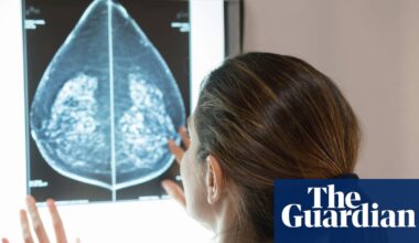 AI can detect heart disease in women using mammograms, study suggests | Women's health