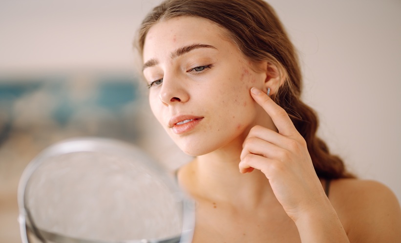 Formaldehyde Contact Allergy Remains a Global Concern