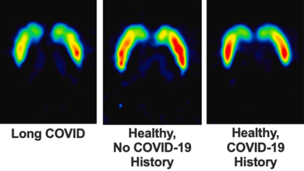Long COVID Linked to Lasting Damage in The Brain's Dopamine System : ScienceAlert