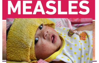 Measles cases spread in Allegany County, new confirmed case in Steuben County