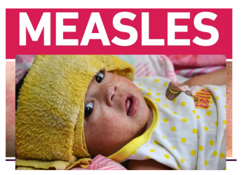 Measles cases spread in Allegany County, new confirmed case in Steuben County
