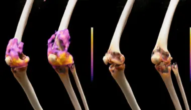 A cancer therapy put severe rheumatoid arthritis into remission