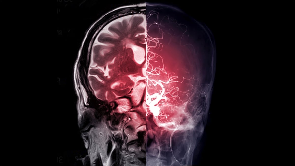 Diabetes Drug Used For More Than 60 Years Found to Unexpectedly Affect The Brain : ScienceAlert