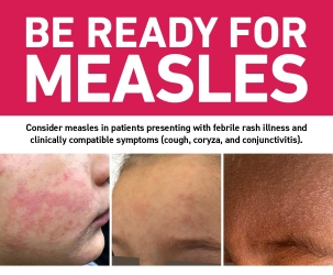 MEASLES UPDATE: Allegany County Department of Health Issues Updated Public Health Advisory