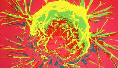 Protein scaffold drives growth and spread of aggressive breast cancer