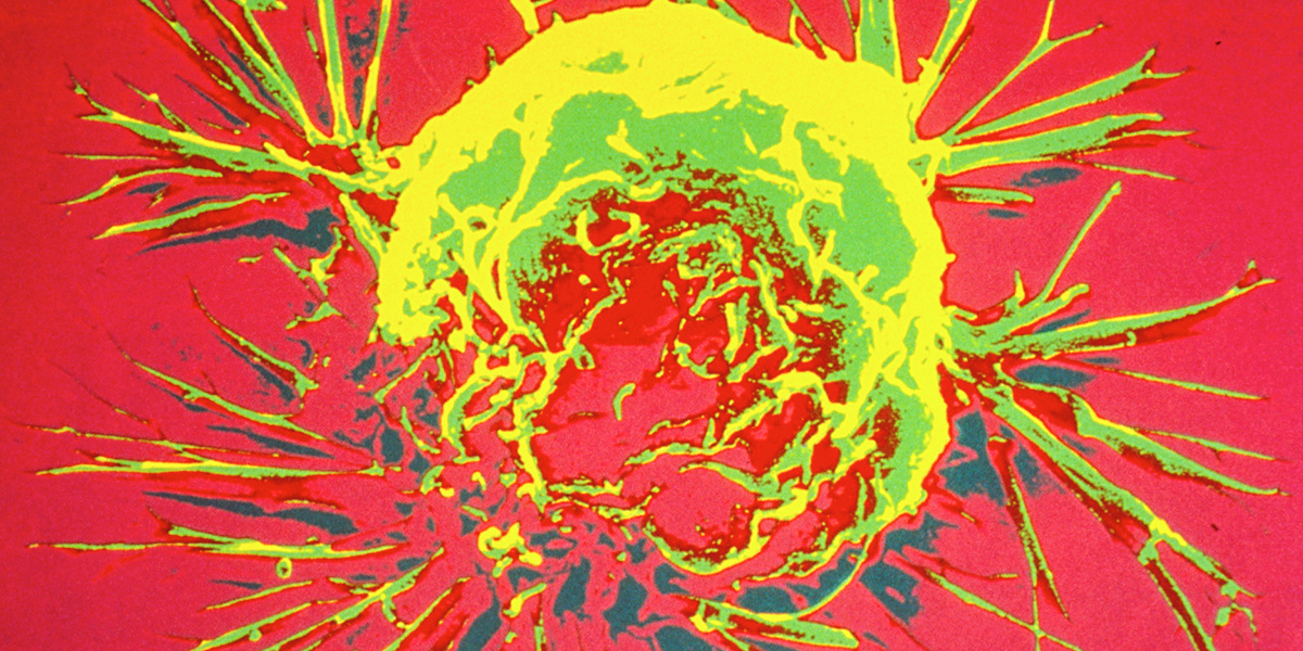 Protein scaffold drives growth and spread of aggressive breast cancer