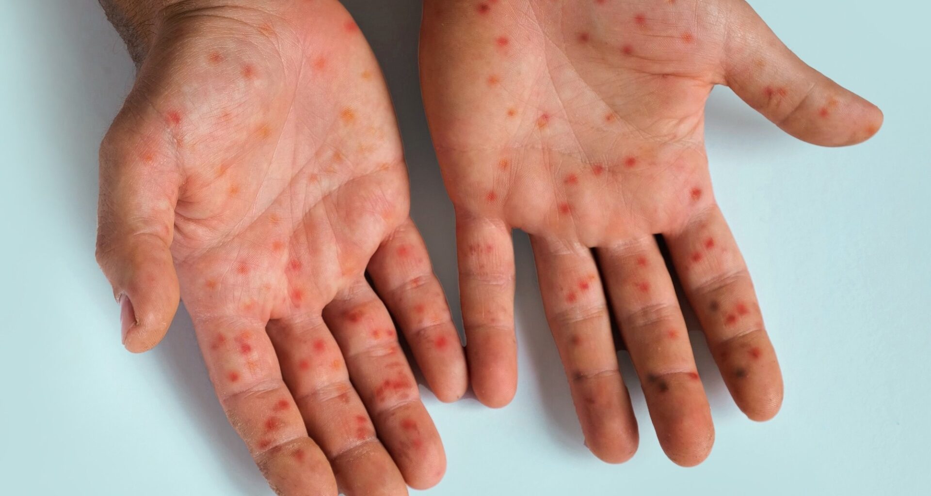 Commentary: Measles as tracer and tugboat: Why eradication can strengthen immunization systems. Image Credit: Marina Demidiuk / Shutterstock