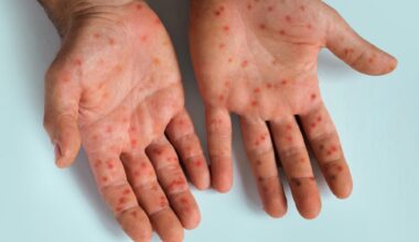 Commentary: Measles as tracer and tugboat: Why eradication can strengthen immunization systems. Image Credit: Marina Demidiuk / Shutterstock