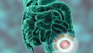 colon colorectal cancer