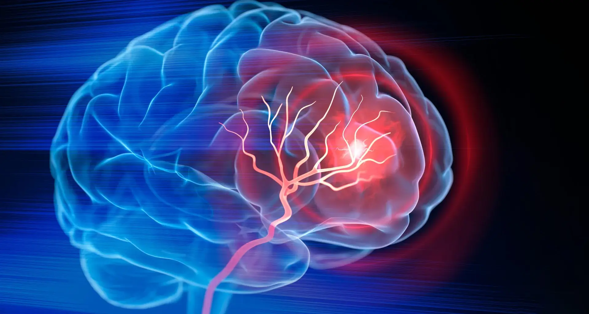 New injectable treatment helps the brain rebuild after stroke