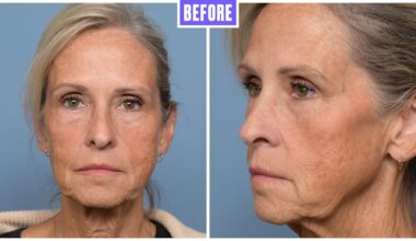 Woman, 60, Undergoes Facelift for Her ‘Ozempic Face’