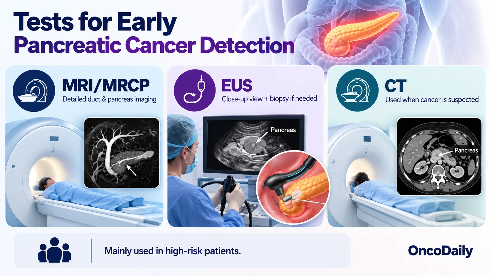 Can Pancreatic Cancer Be Detected Early? Symptoms, Biomarkers, and New Tests 8 Can Pancreatic Cancer Be Detected Early? Symptoms, Biomarkers, and New Tests