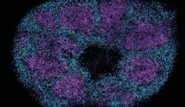 Scientists map key protein interactions linked with profound autism : NPR