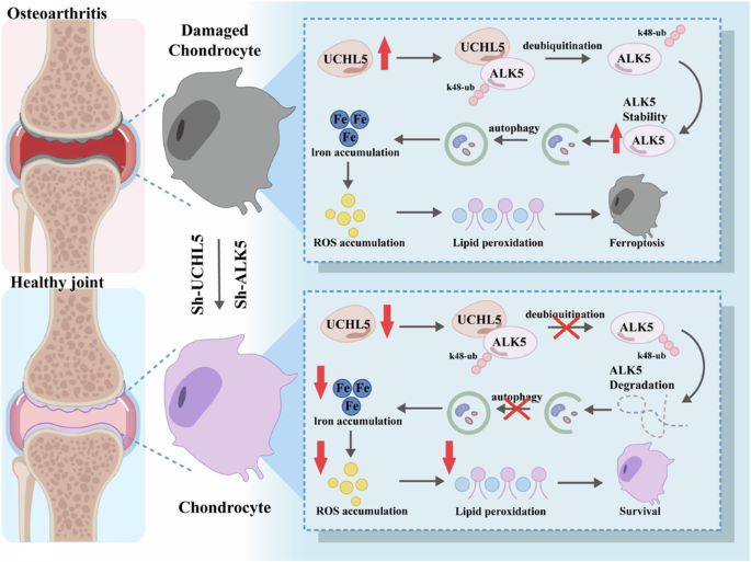 UCHL5 stabilizes ALK5 to promote autophagy dependent ferroptosis in osteoarthritis