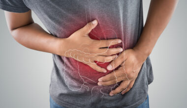 JAK Inhibitors and Reduction of Colectomy Risk for Patients With Acute Severe Ulcerative Colitis
