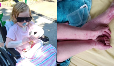 Families demand PBS access to life-changing eczema drug for young children