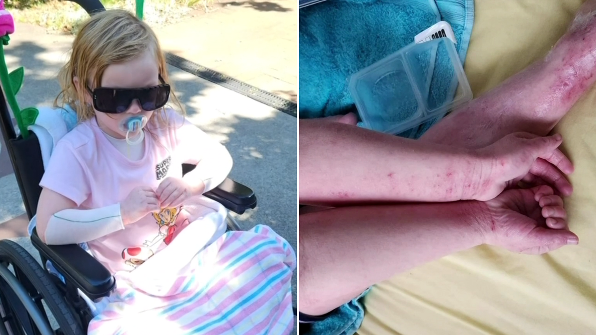 Families demand PBS access to life-changing eczema drug for young children