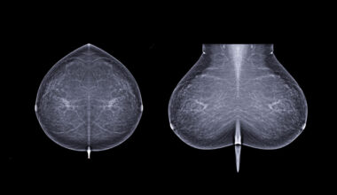 Why this startup is taking its AI to predict breast-cancer risk directly to patients