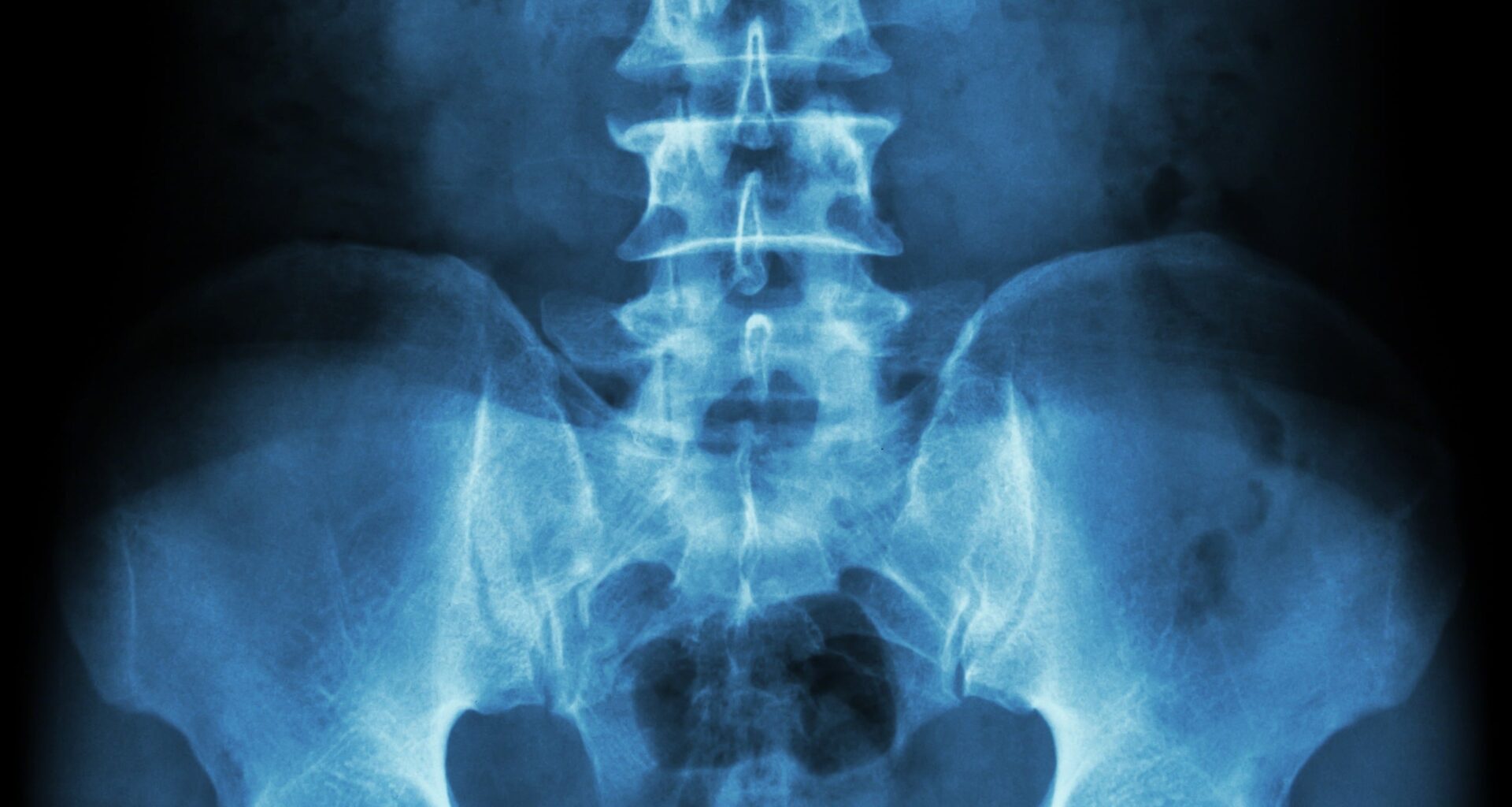 Testosterone May Have an Unexpected Benefit For Women's Bones After Menopause : ScienceAlert