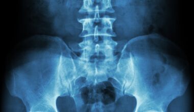 Testosterone May Have an Unexpected Benefit For Women's Bones After Menopause : ScienceAlert