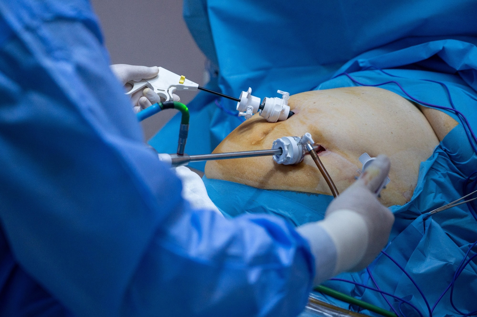 Study: Associations of postoperative vitamin D with body composition changes after bariatric surgery: a prospective cohort study. Image Credit: Subway84 / Shutterstock