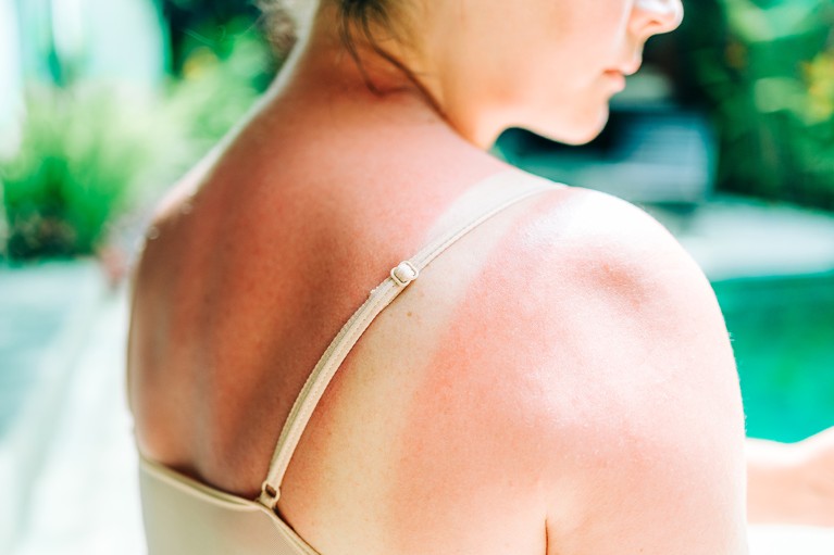 Close-up of a person’s upper back and shoulder showing red, irritated skin consistent with sunburn. A light-coloured shoulder strap crosses the shoulder.
