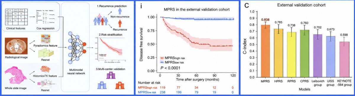 Dr. Sharma also discussed the potential advantages of integrating multiple biomarker modalities rather than relying on a single source of prognostic information. Zhang et al.14 evaluated an MMAI model incorporating clinical characteristics, radiographic features, and digital histopathology for prognostication in clear cell RCC. The study included 1,648 patients from six centers and the TCGA. The multimodal model demonstrated an AUC of 0.84, compared with approximately 0.70 for the compressed Leibovich score: