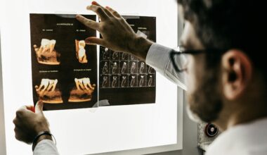 First Large-scale Alzheimer Disease Study In Brain Tissue From African American Donors Implicates Roles For Many Novel Genes