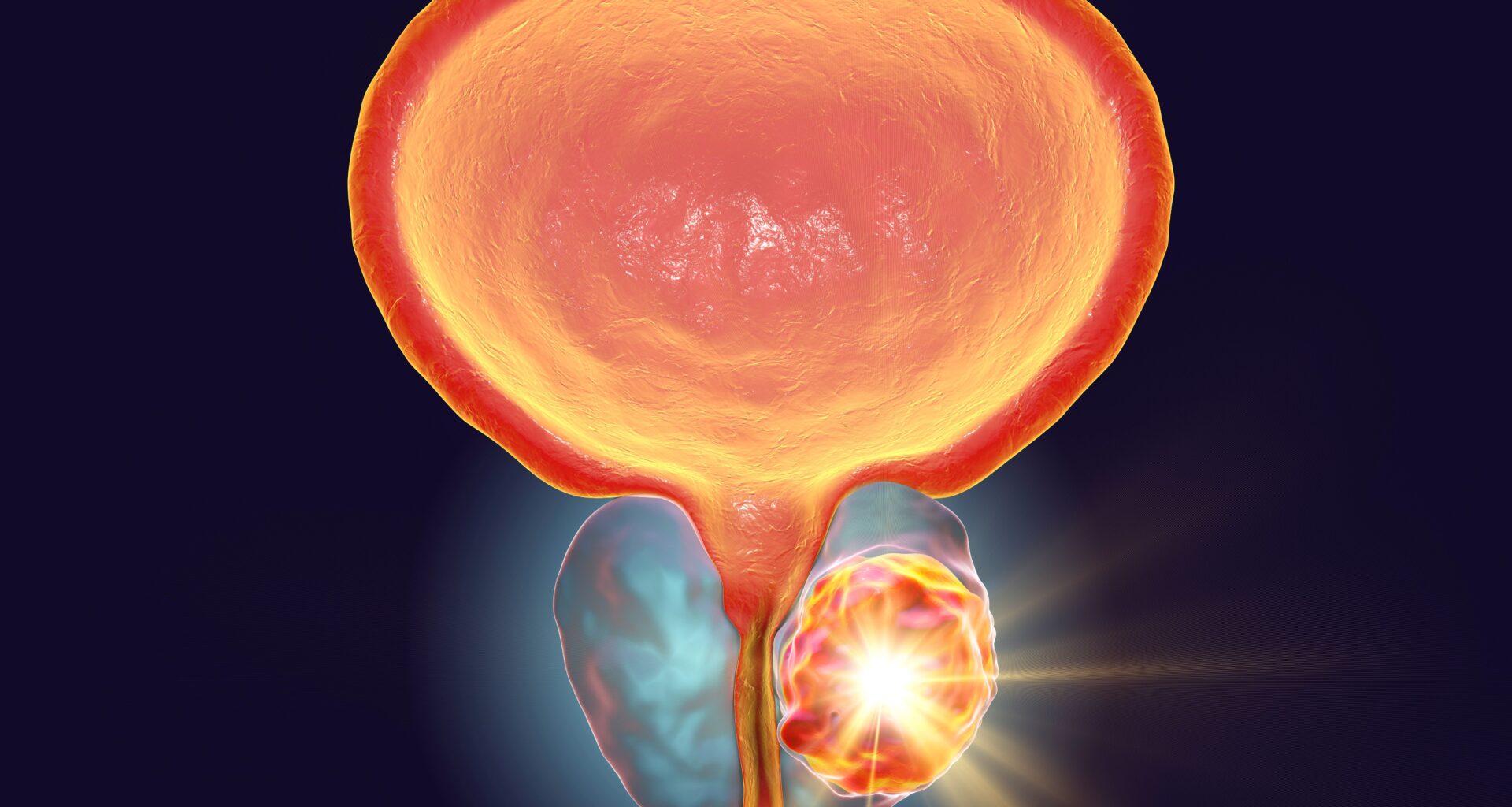 Data from the ROSELLA trial show a consistent benefit with relacorilant plus nab-paclitaxel across PROC subgroups.