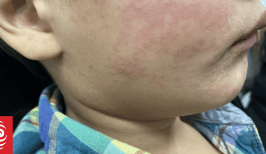 Measles spread modelling considers 150 cases a week possible