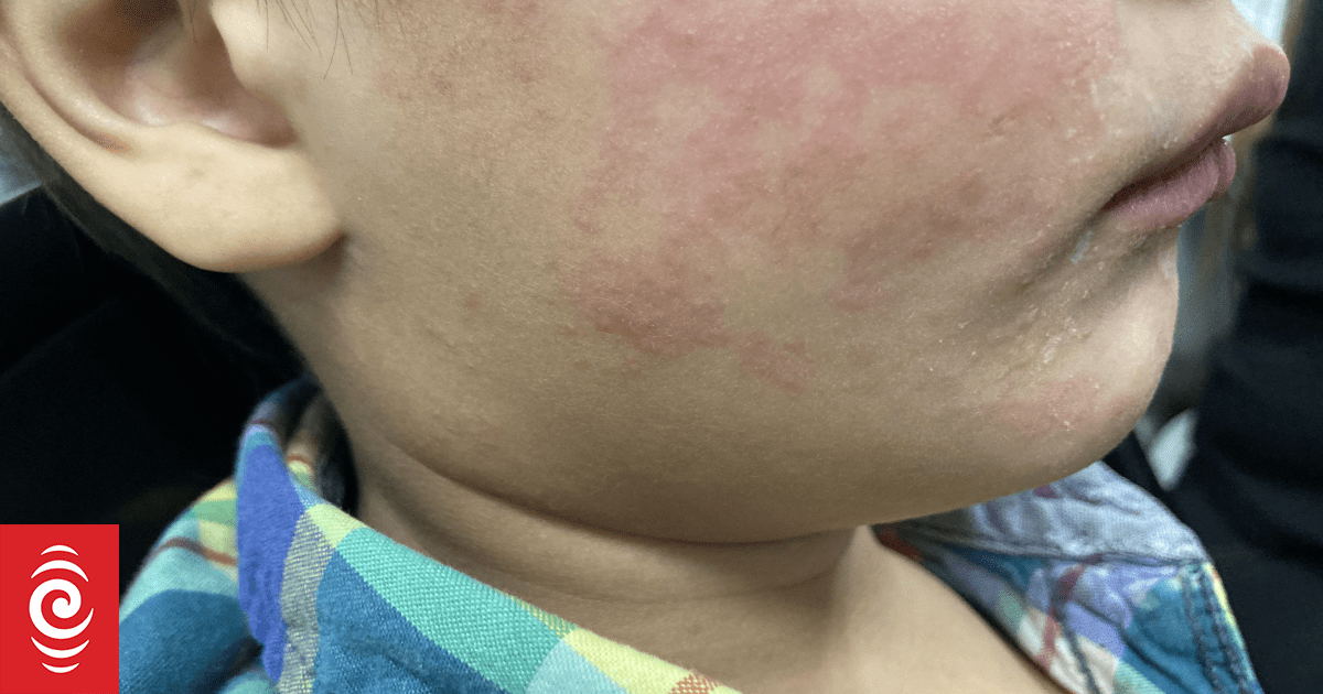 Measles spread modelling considers 150 cases a week possible