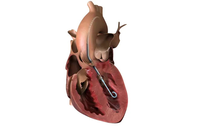 Cybersecurity triggers another recall of J&J’s Impella heart pump controller