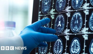Dementia diagnosis revolutionised by AI and new blood tests