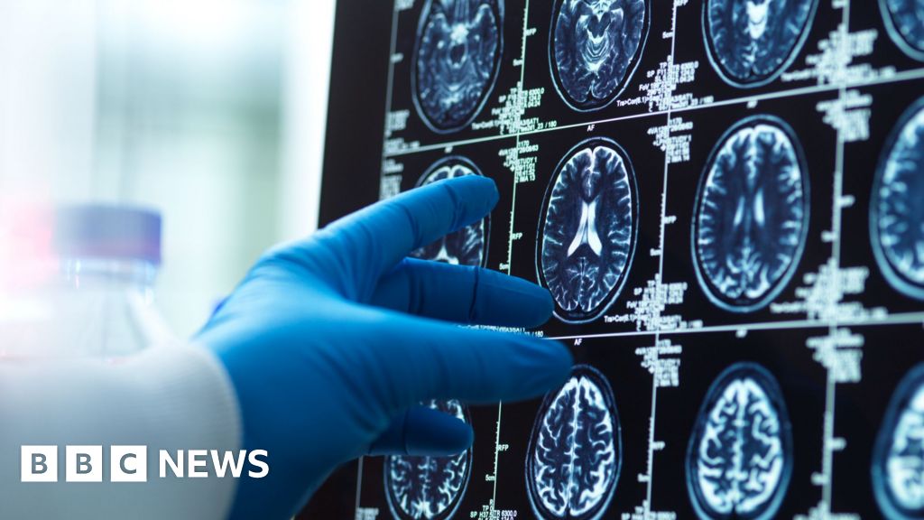 Dementia diagnosis revolutionised by AI and new blood tests