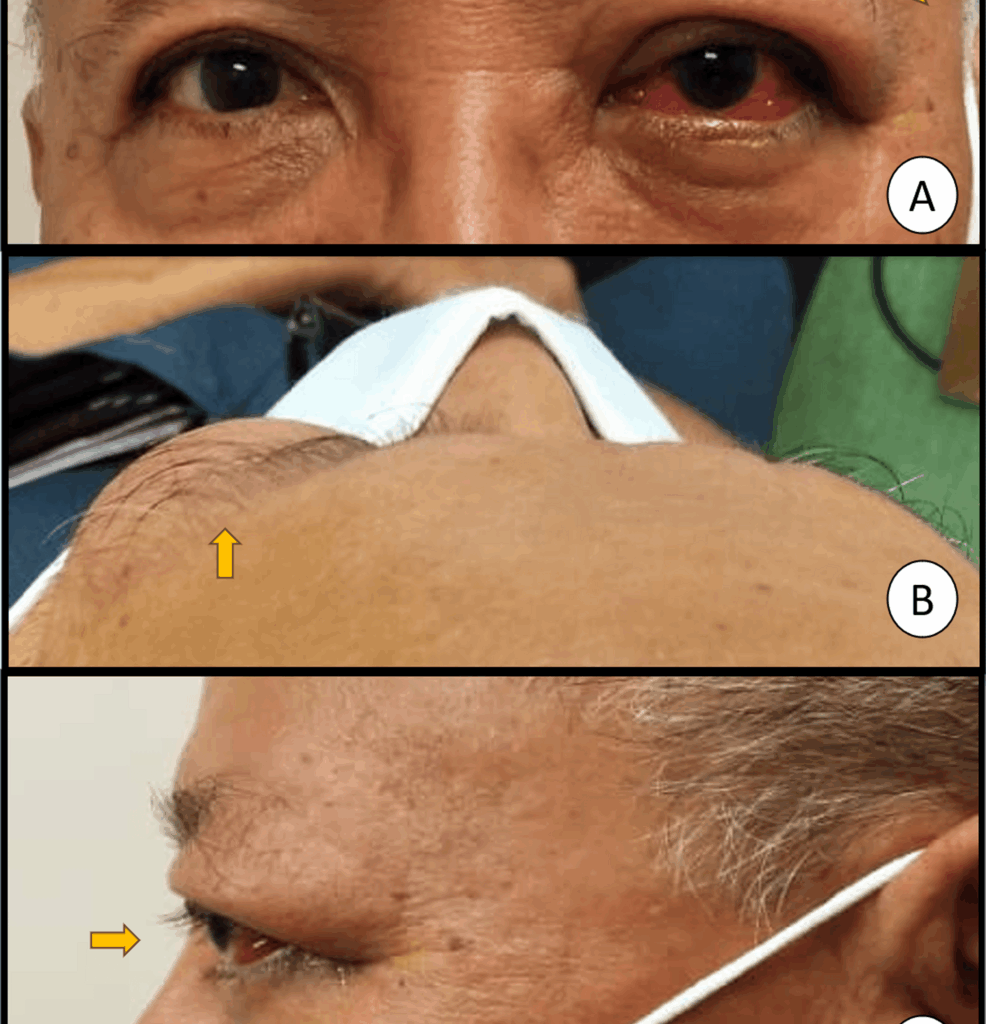 When Postoperative Inflammation Isn’t Benign: Thyroid Eye Disease Following Cataract Surgery